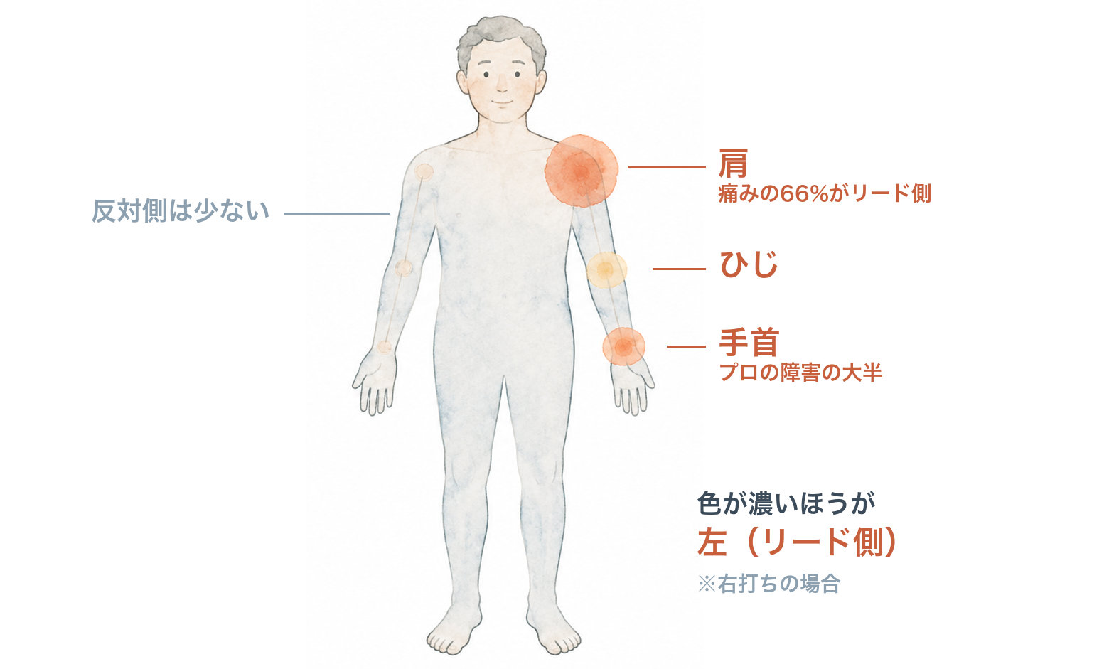 体の左側（リード側）に肩・肘・手首の障害が集中することを示した人体図